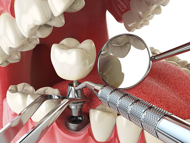 Best Emergency Root Canal Treatment in Roaming Shores, OH